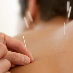 Acupuncture on back